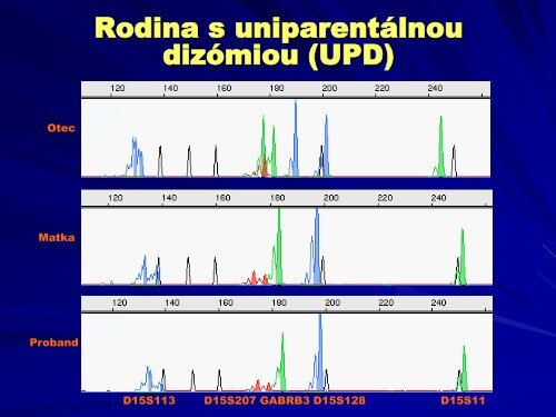príklady poruchy genómového imprintingu - datasolution.sk