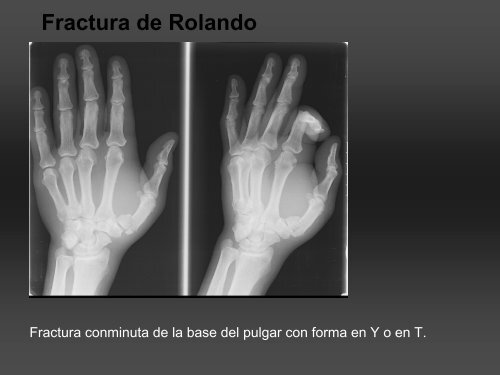 RADIOLOGÍA DE LA MANO