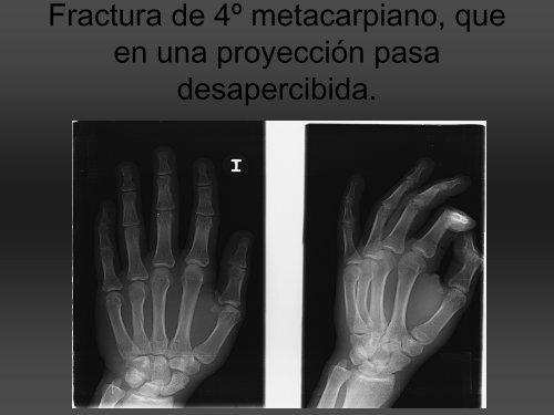 RADIOLOGÍA DE LA MANO