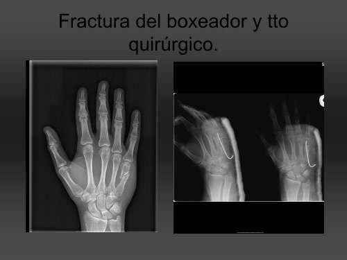 RADIOLOGÍA DE LA MANO