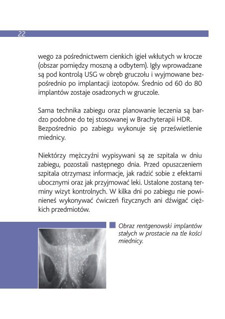 Brachyterapia raka gruczoÅu krokowego - Wielkopolskie Centrum ...