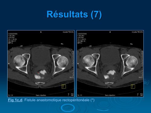 Apports du scanner multibarrette dans l'Ã©valuation des fistules ...