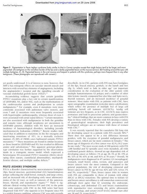 The lentiginoses: cutaneous markers of systemic disease and a ...