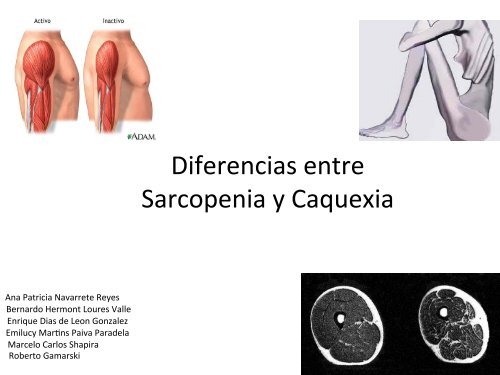 Diferencias entre Sarcopenia y Caquexia