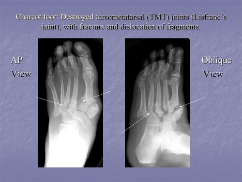 Acute Clinical Presentation of Charcot Arthropathy