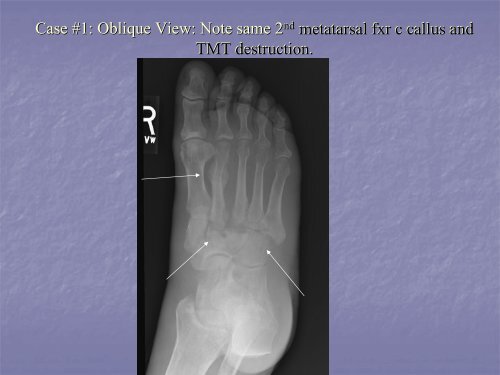 Acute Clinical Presentation of Charcot Arthropathy