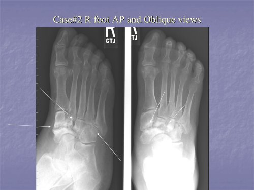 Acute Clinical Presentation of Charcot Arthropathy