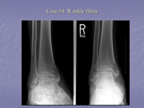 Acute Clinical Presentation of Charcot Arthropathy