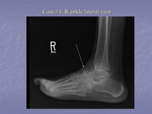 Acute Clinical Presentation of Charcot Arthropathy