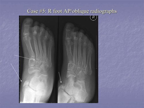 Acute Clinical Presentation of Charcot Arthropathy