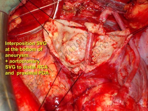 RCA aneurysm repair - cardioegypt2011