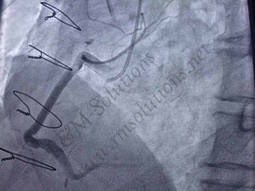 RCA aneurysm repair - cardioegypt2011