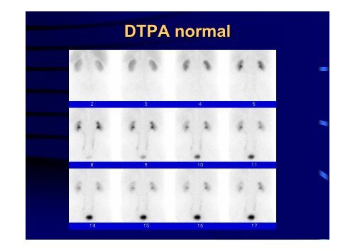 Diuretic Renal Scan Interpretation