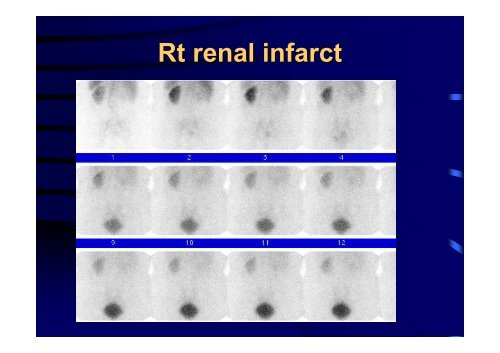 Diuretic Renal Scan Interpretation