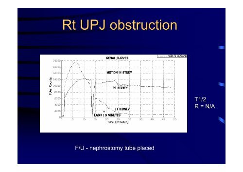 Diuretic Renal Scan Interpretation