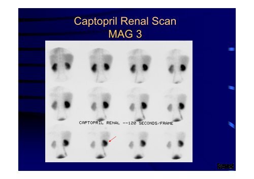 Diuretic Renal Scan Interpretation