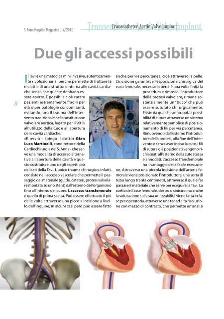 Transcatheter Aortic Valve Implant - S.Anna hospital