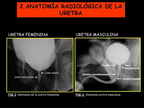 uretra anterior