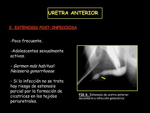 uretra anterior