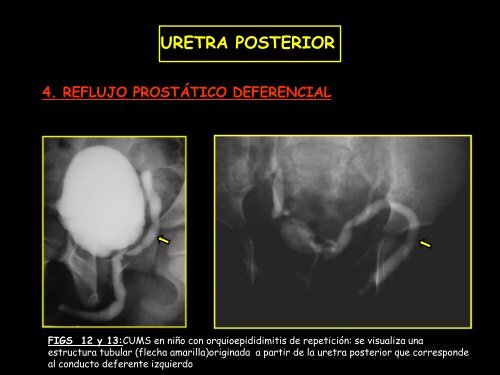 uretra anterior