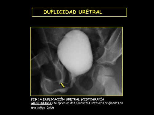 uretra anterior