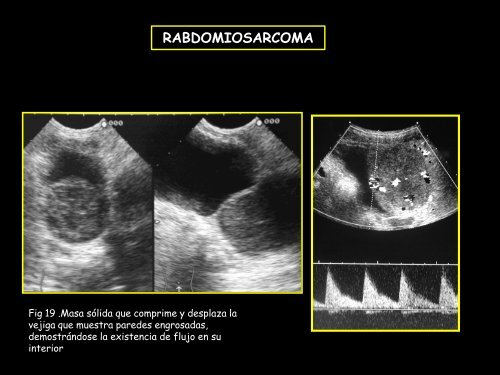 uretra anterior