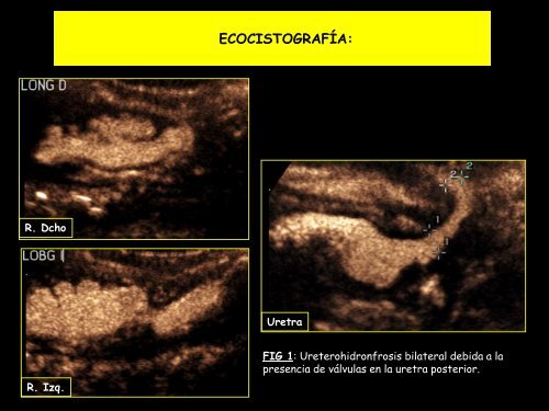 uretra anterior