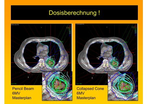 Atemtriggerung - Strahlentherapie