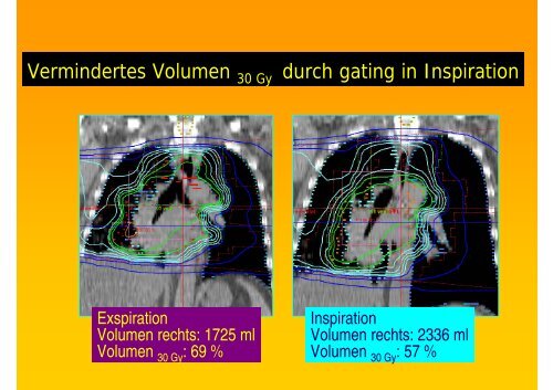 Atemtriggerung - Strahlentherapie