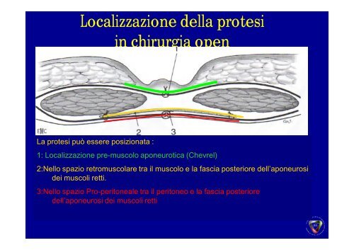 Ernia Ombelicale - Cattedra Chirurgia Tor Vergata