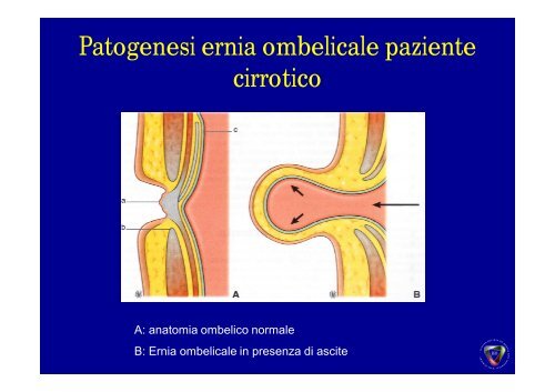 Ernia Ombelicale - Cattedra Chirurgia Tor Vergata