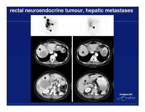 (PRRT) of Gastro-Entero-Pancreatic NeuroEndocrine Tumors