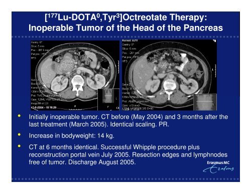 (PRRT) of Gastro-Entero-Pancreatic NeuroEndocrine Tumors