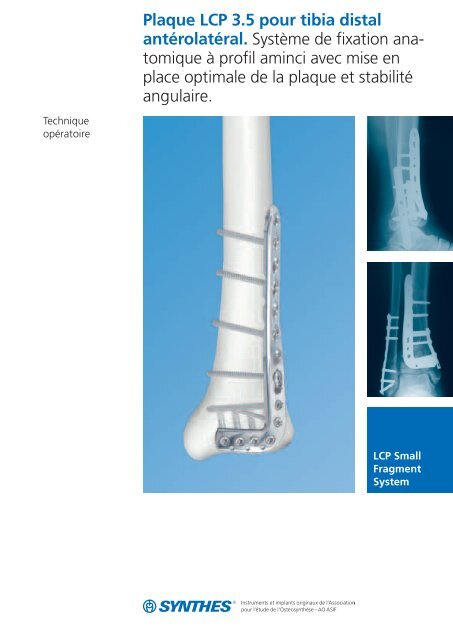 Plaque LCP antÃ©rolatÃ©rale pour tibia distal - Synthes