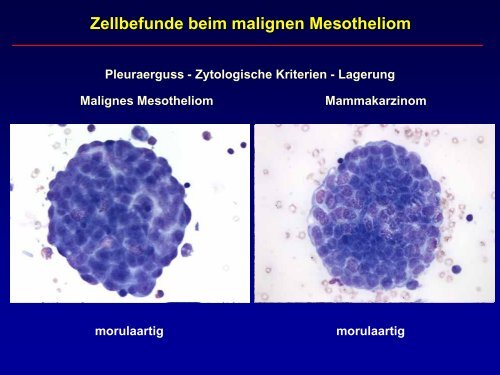 Zellbefunde beim malignen Mesotheliom - Krankenhaus St ...