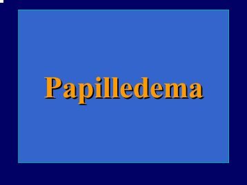 Il Papilledema - Fondazione "GB Bietti"