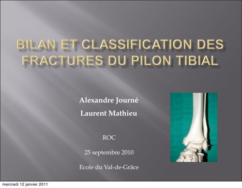 Bilan des fractures du pilon tibial - ClubOrtho.fr