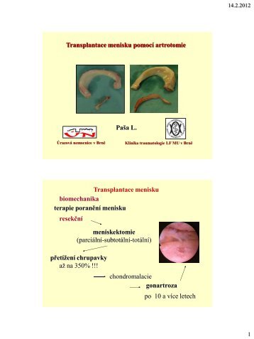 Transplantace menisku pomocí artrotomie (PDF - 0,86 MB) - SSTA