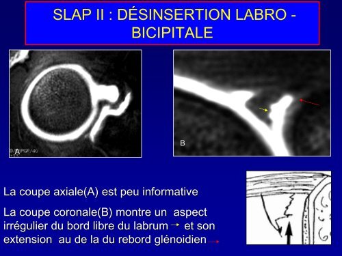 guide d'interprÃ©tation d'une lÃ©sion du labrum glÃ©noidien supÃ©rieur ...