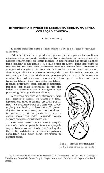 hipertrofia e ptose do lÃ³bulo da orelha na lepra. correÃ§Ã£o plÃ¡stica