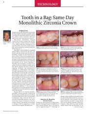 Tooth in a Bag: Same-Day Monolithic Zirconia Crown - Eureka Smile ...