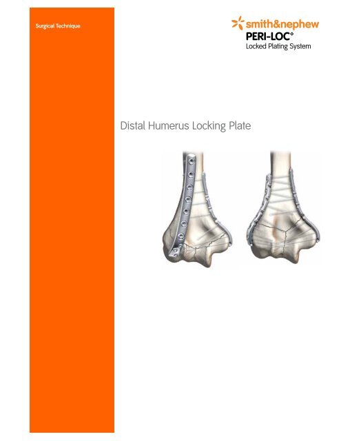 Distal Humerus Locking Plate - Osteosyntese