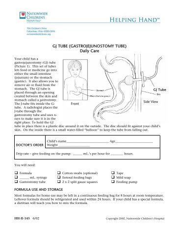 GJ TUBE (GASTROJEJUNOSTOMY TUBE) Daily Care