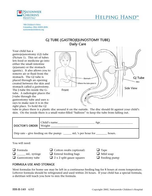 Gj Tube Gastrojejunostomy Tube Daily Care