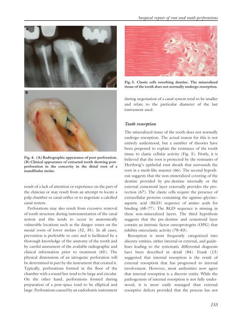 Surgical repair of root and tooth perforations - Wiley Online Library