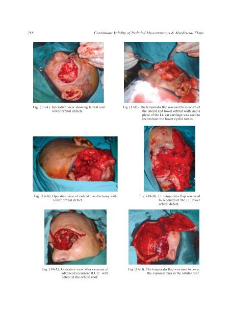 Continuous Validity of Pedicled Myocutaneous and Myofascial ... - NCI