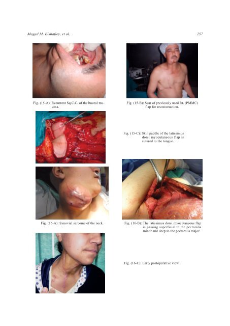 Continuous Validity of Pedicled Myocutaneous and Myofascial ... - NCI