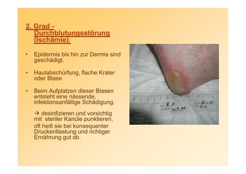 fingertest-r-tung-dekubi