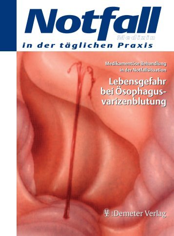 varizenblutung - Curatis-pharma.de