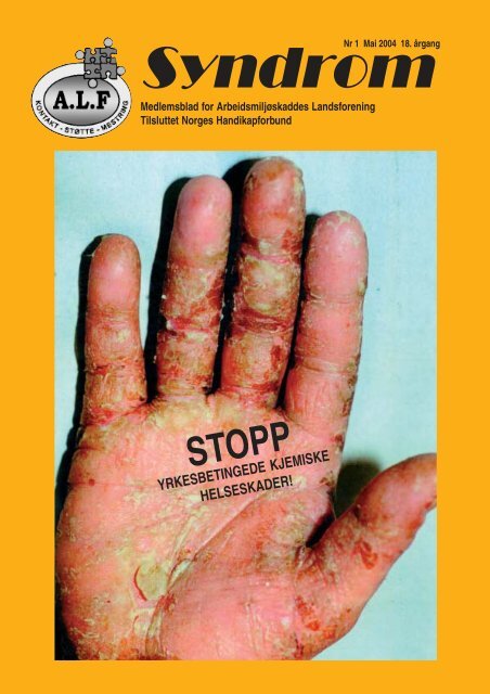 Syndrom Nr 1 - 2004 - Arbeidsmiljøskaddes landsforening